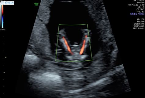 13 Week Ultrasound Pictures Gender