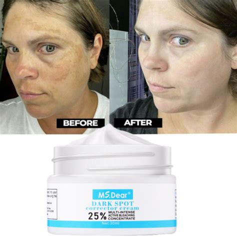 Buy Dark Spots Melasma Remover Anti Aging Face Cream Skin Bleaching