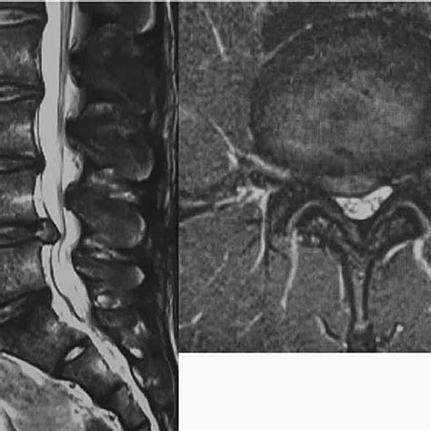 Magnetic Resonance Imaging Mri T2 Weighted Sagittal And Axial View