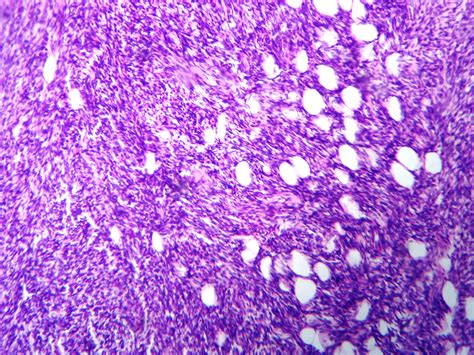 Malignant Phyllodes Tumor Pathology Outlines Bosnianpathology Org