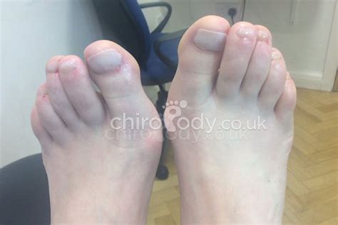 Toenail Reconstruction Cosmetic Podiatry Treatments Chiropody Co