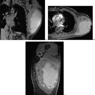 Patient 1 post-contrast MRI of right thigh tumor. (A) T1 fat-saturated... | Download Scientific ...