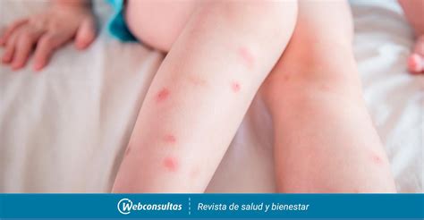 Reparatur Monatlich Gurt Como Son Las Picaduras De Mosquitos Zwei