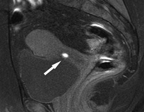 Deep Retroperitoneal Pelvic Endometriosis Mr Imaging Appearance With Laparoscopic Correlation