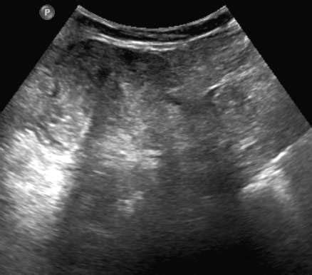 Spigelian Hernia Ultrasound