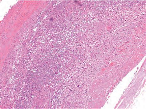 Metastatic Undifferentiated Pleomorphic Sarcoma Semantic Scholar