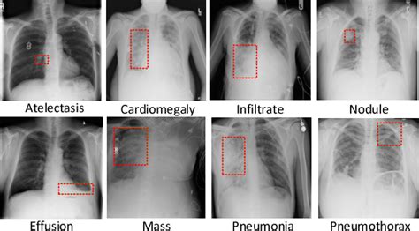 Pdf Weakly Supervised Deep Learning For Thoracic Disease