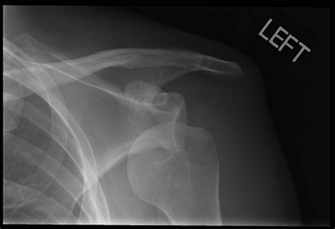 Dislocated Shoulder