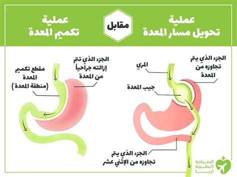 تحويل مسار المعدة وتكميم المعدة أي عملية أفضل بينهما؟ آريا مدتور