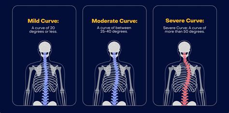 Adolescent Idiopathic Scoliosis What You Need To Know National Spine