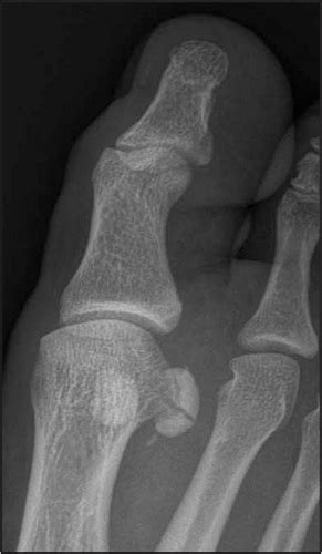 Sesamoid Bone Fracture