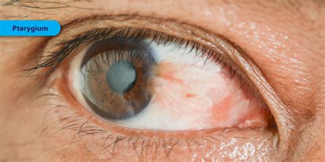 Pterygium Symptoms Causes And Treatment Fyeyes