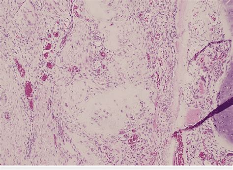 Histological Features Of The Low Grade Chondrosarcoma At Magnification