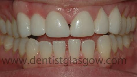 Gap Between Front Teeth: Same Day Porcelain Veneers Case Study