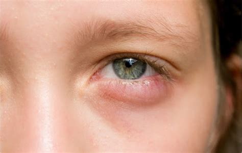 Eyelid Disease Blepharitis