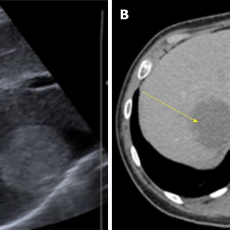 Hepatic Hemangioma Of 49 Mm × 30 Mm A Non Contrast Phase B Arterial