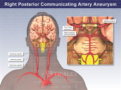 Right Posterior Communicating Artery Aneurysm TrialQuest Inc