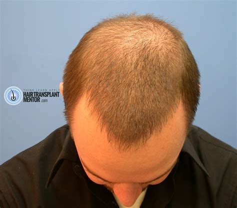 Looking For Hair Transplant Repair Results