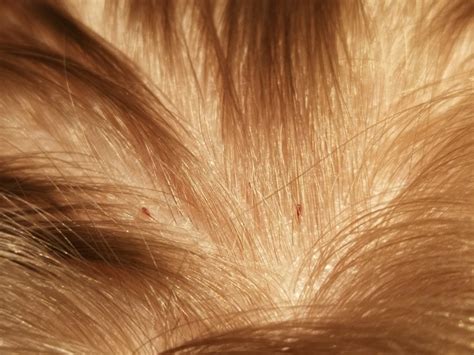 Head Lice And Nits Hseie