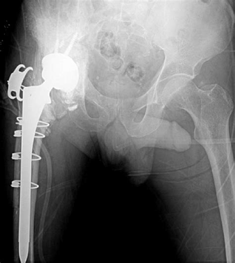 Right Hip Metallosis And Ceramic Fragments Inferior To Acetabular Download Scientific Diagram