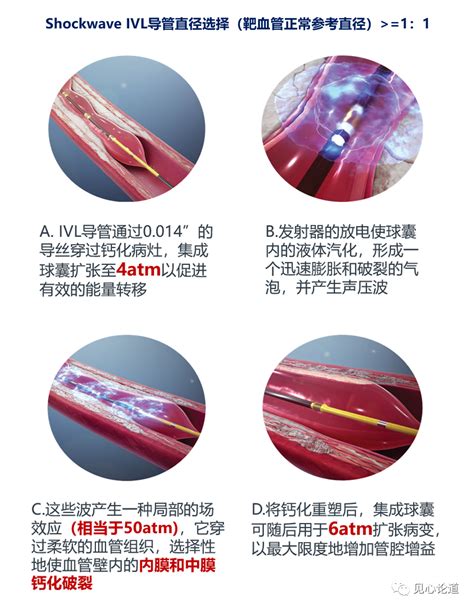 壹生资讯 经皮冠状动脉血管内冲击波能量钙化碎裂术ivl——钙化病变介入新进展 健心知著