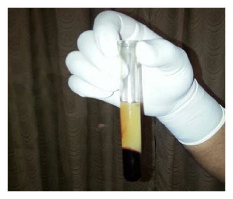 Preparation Of Platelet Rich Fibrin Download Scientific Diagram