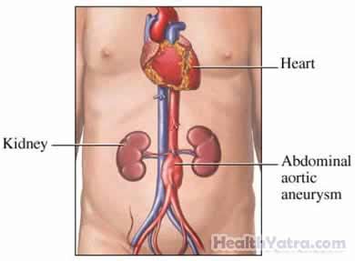 Best Cost Abdominal Aortic Aneurysm Repair Surgery, Treatment Hospital ...