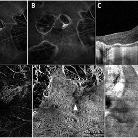 Fluorescein Angiography Structural Optical Coherence Tomography