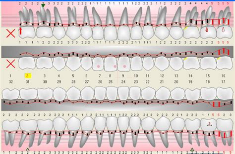 Dentist Dublin Periodontal Charting