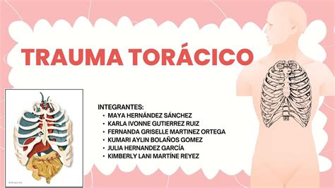 Trauma Torácico Karen Alexandra Martinez Reyes Udocz