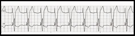 Float Nurse: Practice EKG Strips 429