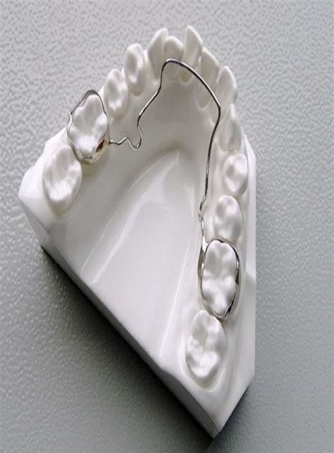 Lower Lingual Holding Arch Appliance Explained Orthodontic Appliances