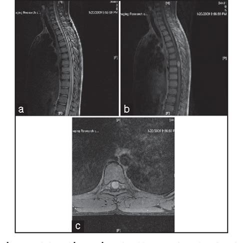 Figure 1 From Intramedullary Meningioma Of Spinal Cord Case Report Of