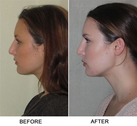 Turbinate Reduction Septoplasty Nasal Septum Sinus Surgery Sinusitis