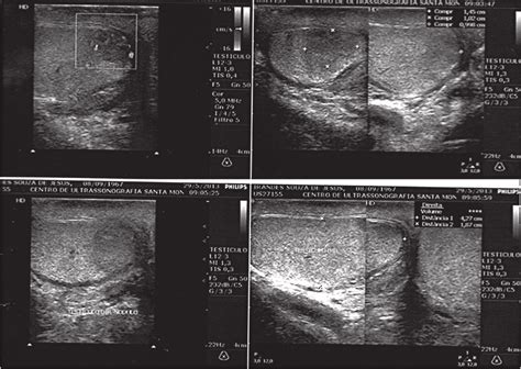 Ultrasonography Of The Right Testis A Hypoechoic Nodule In The Lower