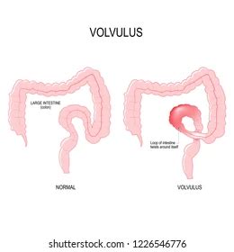 Large Bowel Obstruction Flashcards Quizlet