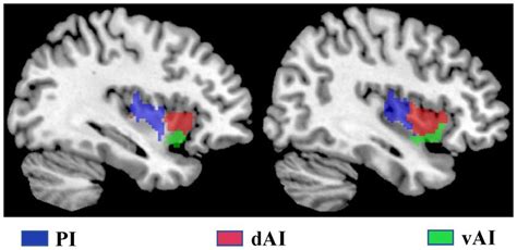 Frontiers Altered Functional Connectivity Of Insular Subregions In Subjective Cognitive Decline