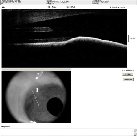 Image of sclerectomy-combined Ahmed glaucoma valve implantation into ...