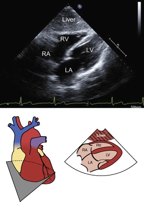 Transthoracic Echocardiography Standard Views | Anesthesia Key