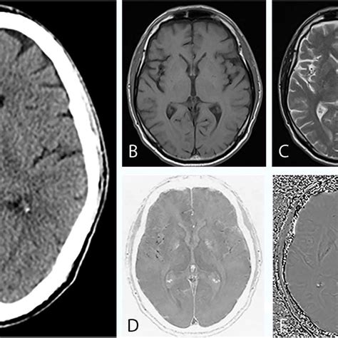 Imaging findings of a 63-year-old man with a calcified pineal gland.... | Download Scientific ...