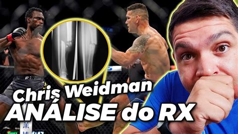 Chris Weidman Quebra A Perna Ap S Chute No Ufc Igual A Anderson