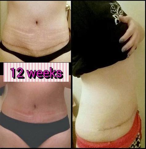 Short Scar Tummy Tuck After Tummy Tuck Prices Photos Reviews Info Qanda