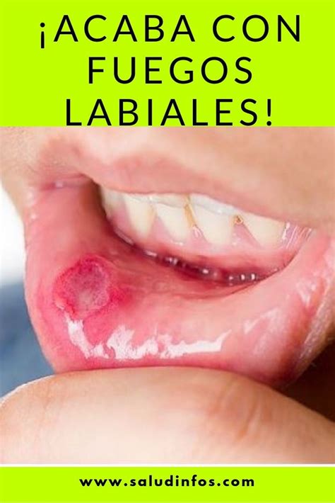 Acaba Con Fuegos Labiales Fuegos Labiales Remedios Para Fuegos