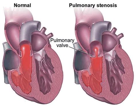 Pulmonic Stenosis Pulmonic Stenosis Pulmonic Stenosis Treatment Health Informations