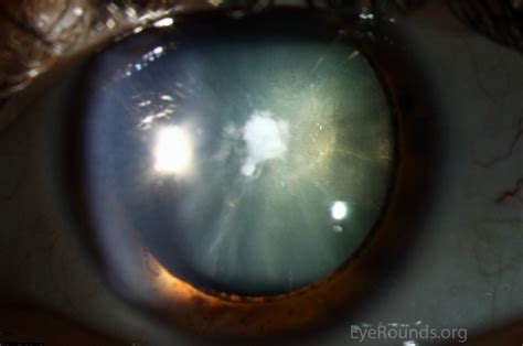 Combined Anterior Polar Posterior Subcapsular And Cortical Cataract