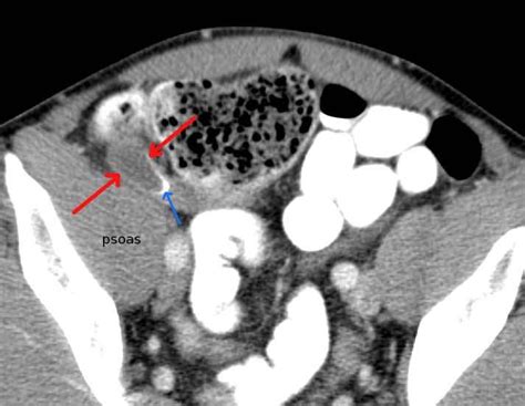 Rit Radiology Appendiceal Mucocele