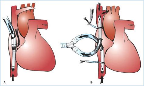 Cardiopulmonary Bypass Equipment Circuits And Pathophysiology Anesthesia Key