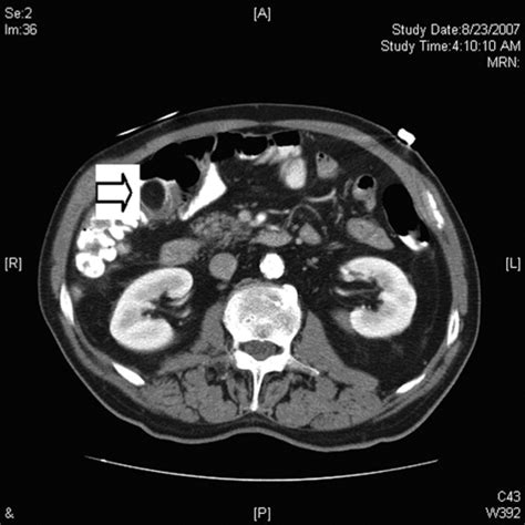 Ct Image Of Mass Preoperatively Demonstrating A 19 Cm × 15 Cm Lesion