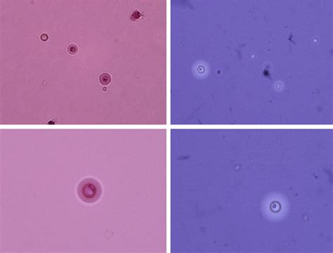 Figure 1 From A Case Of Cryptococcal Meningitis Successfully Treated