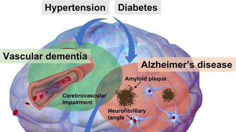 Understanding Vascular Dementia Risk Factors Impact And Prevention